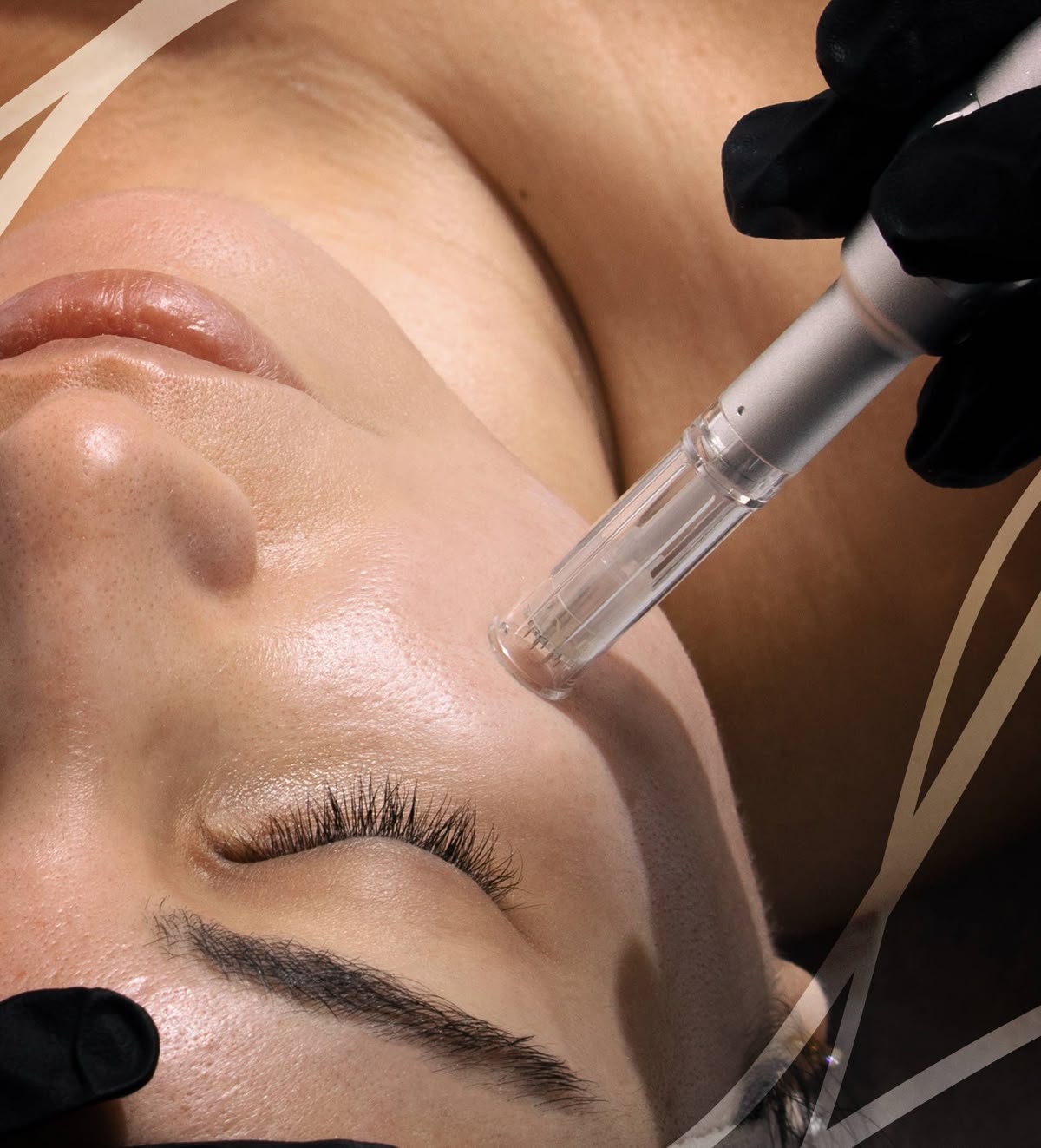 Collagen Induction Therapy