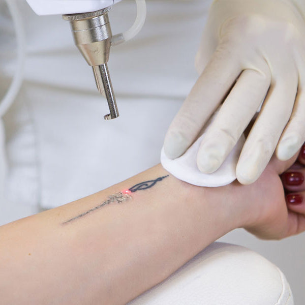 Laser Tatto Removal